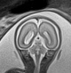 Normal brain fetal MRI - 22 weeks (Radiopaedia 50623-56050 Coronal T2 Haste 9).jpg