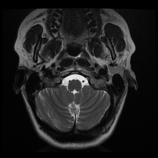 File:Normal cervical and thoracic spine MRI (Radiopaedia 35630-37156 Axial T2 34).png