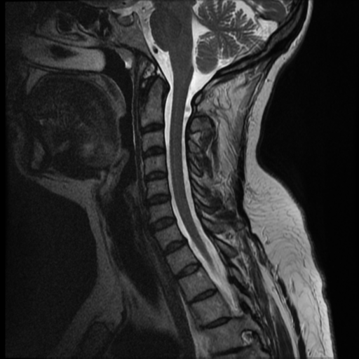 File:Normal cervical and thoracic spine MRI (Radiopaedia 35630-37156 Sagittal T2 6).png