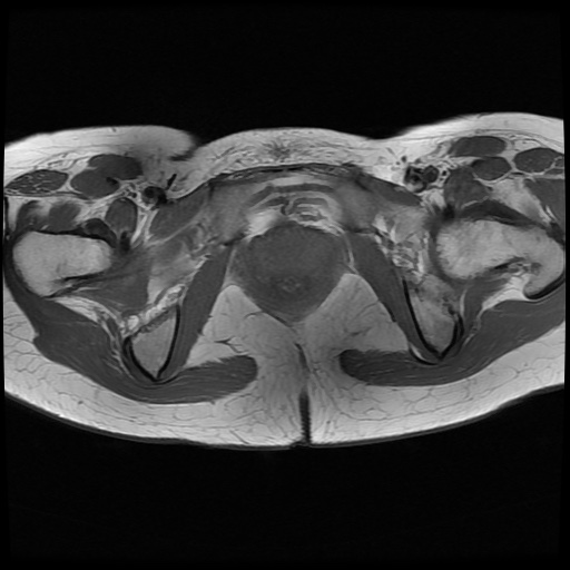 File:Normal female pelvis MRI (retroverted uterus) (Radiopaedia 61832-69933 Axial T1 25).jpg