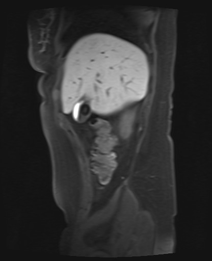 File:Normal hepatobiliary phase liver MRI (Radiopaedia 58968-66230 C 15).jpg