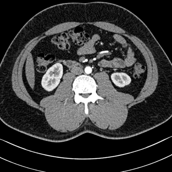 Normal kidneys on 4-phase CT study (Radiopaedia 25889-26038 B 64).jpg