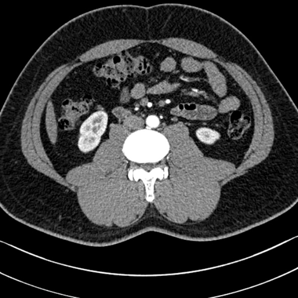 Normal kidneys on 4-phase CT study (Radiopaedia 25889-26038 B 69).jpg