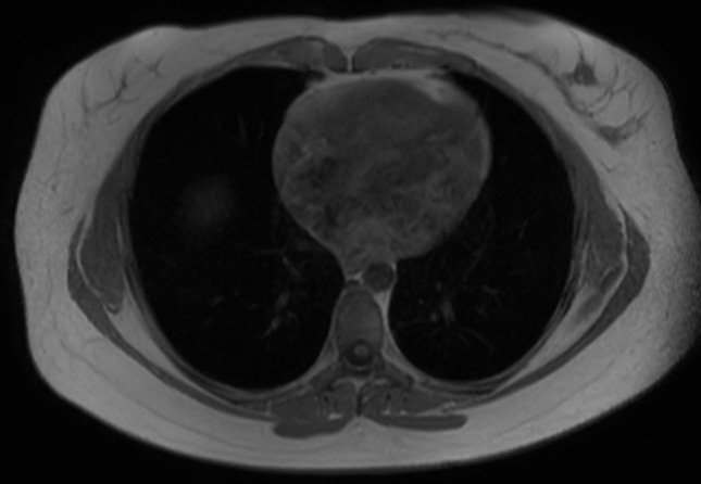 File:Normal liver MRI with Gadolinium (Radiopaedia 58913-66163 Axial T1 in-phase 33).jpg