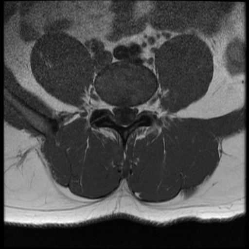 File:Normal lumbar spine MRI (Radiopaedia 35543-37039 Axial T1 14).png