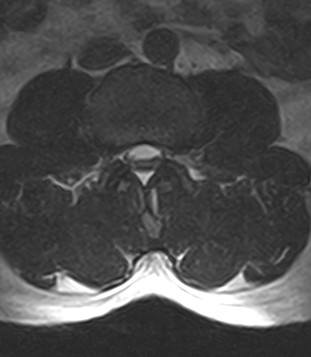 Normal lumbar spine MRI - low-field MRI scanner (Radiopaedia 40976-43699 Axial T2 50).jpg