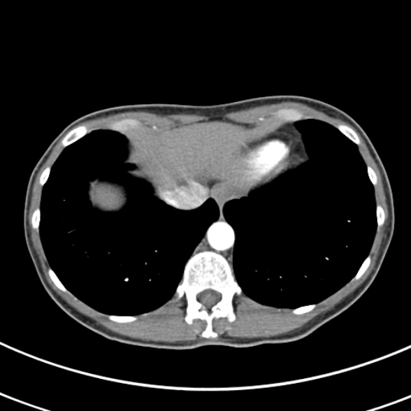 File:Normal multiphase CT liver (Radiopaedia 38026-39996 B 6).jpg