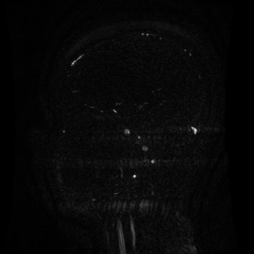 Normal noncontrast MR venography (Radiopaedia 87578-103957 A 110).jpg