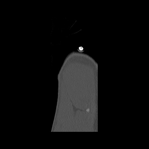 Normal pelvis (Radiopaedia 51473-57238 Sagittal bone window 3).jpg