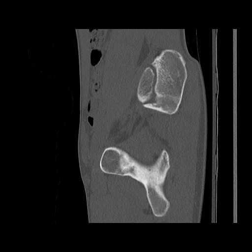 Normal pelvis (Radiopaedia 51473-57238 Sagittal bone window 49).jpg
