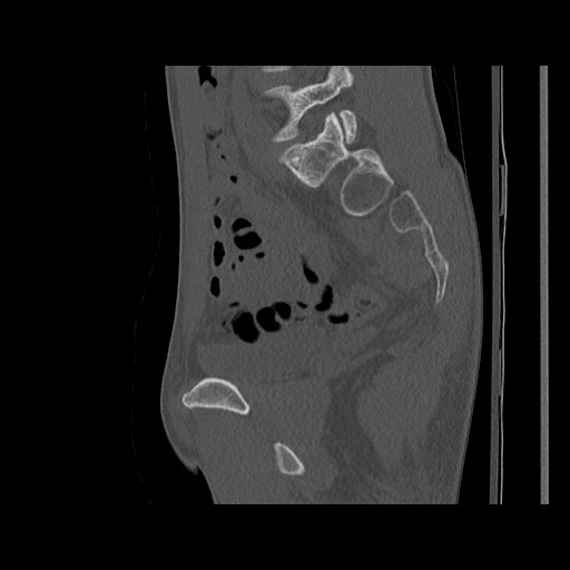 Normal pelvis (Radiopaedia 51473-57238 Sagittal bone window 88).jpg