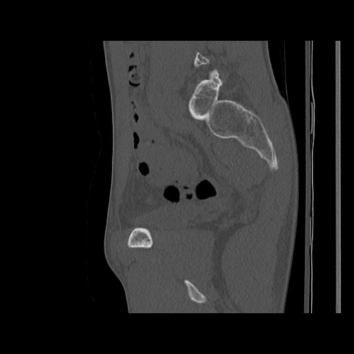 Normal pelvis (Radiopaedia 51473-57238 Sagittal bone window 92).jpg