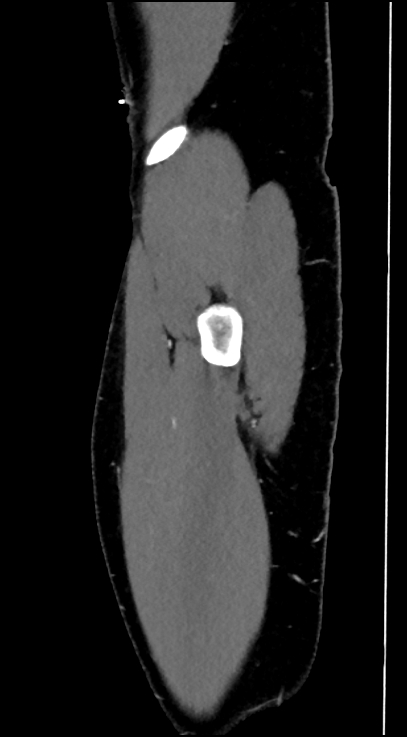 Normal pelvis CT angiogram (Radiopaedia 84966-100481 C 103).jpg