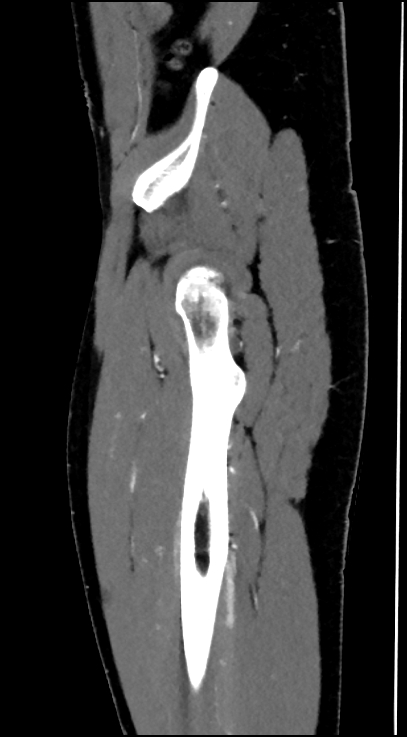 Normal pelvis CT angiogram (Radiopaedia 84966-100481 C 18).jpg