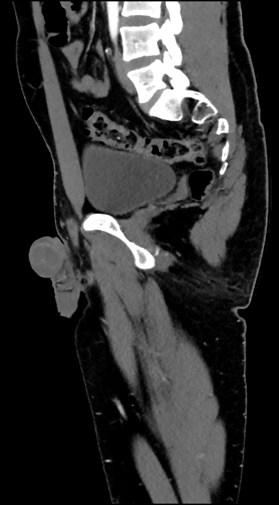 Normal pelvis CT angiogram (Radiopaedia 84966-100481 C 62).jpg
