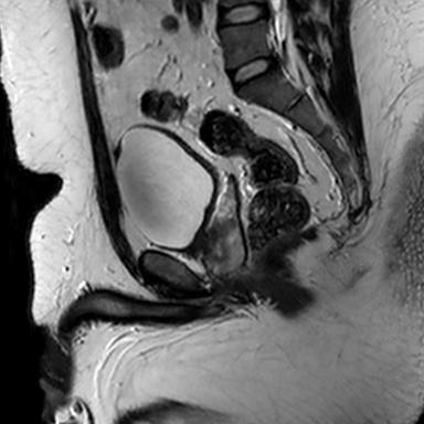 File:Normal prostate (MRI) (Radiopaedia 29986-30535 Sagittal T2 13).jpg
