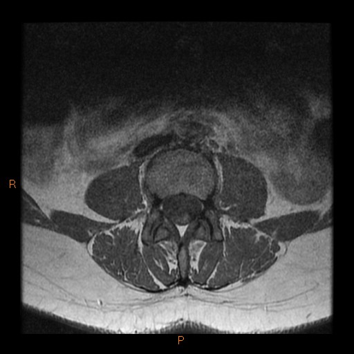 File:Normal spine MRI (Radiopaedia 77323-89408 Axial T1 9).jpg
