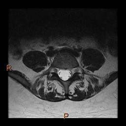 File:Normal spine MRI (Radiopaedia 77323-89408 Axial T2 20).jpg