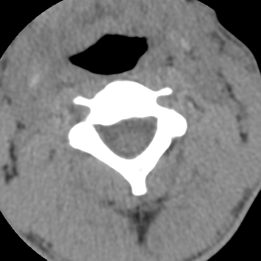 Normal trauma cervical spine (Radiopaedia 41017-43760 Axial non-contrast 23).png