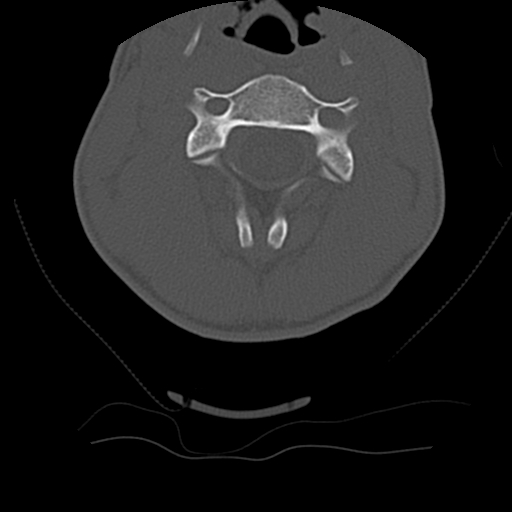 File:Normal trauma spine imaging (age 16) (Radiopaedia 45335-49358 Axial bone window 28).jpg