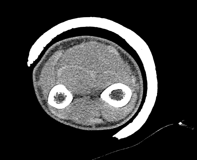 Normal wrist CT (Radiopaedia 41425-44297 Axial non-contrast 56).png