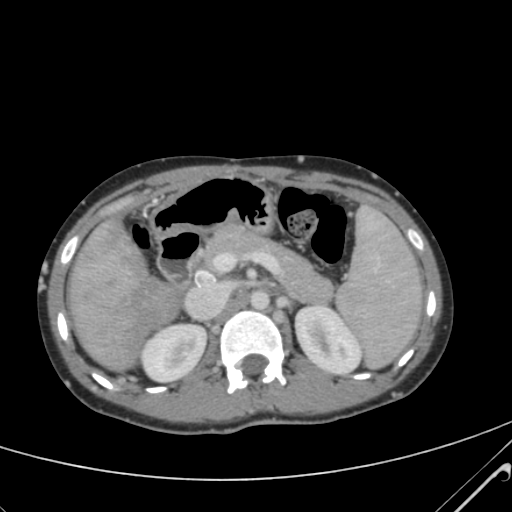 File:Nutmeg liver- Budd-Chiari syndrome (Radiopaedia 46234-50635 B 22).png