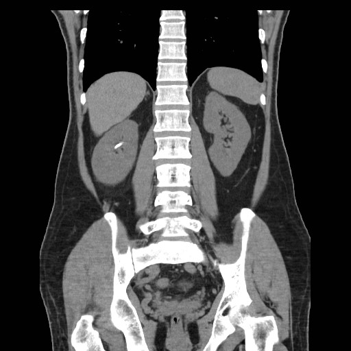 File:Obstructed kidney with perinephric urinoma (Radiopaedia 26889-27067 Coronal non-contrast 19).jpg