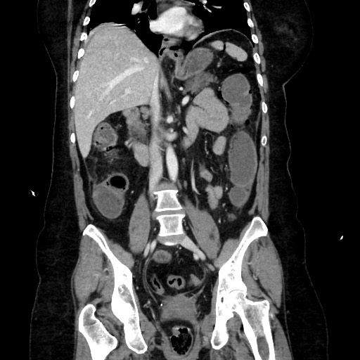 Obstructive distal colonic adenocarcinoma causing cecal perforation (Radiopaedia 86830-102989 C 105).jpg