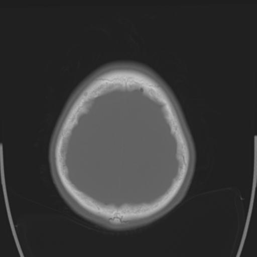 File:Obstructive hydrocephalus (Radiopaedia 30453-31119 Axial bone window 6).jpg