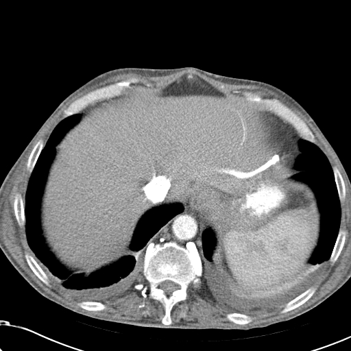 File:Obstructive superior vena cava tumor thrombus (Radiopaedia 28046-28306 A 47).jpg