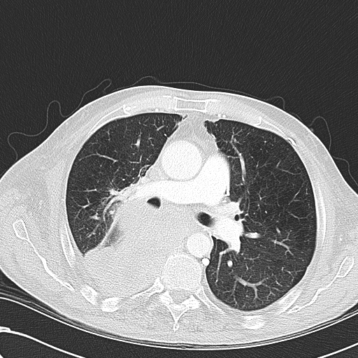 File:Obstructive superior vena cava tumor thrombus (Radiopaedia 28046-28306 Axial lung window 24).jpg
