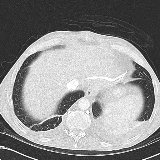 File:Obstructive superior vena cava tumor thrombus (Radiopaedia 28046-28306 Axial lung window 46).jpg