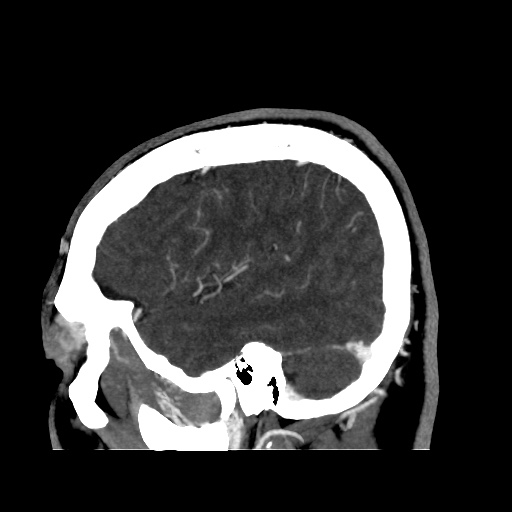 Occipital extradural hematoma simulating venous sinus thrombosis (Radiopaedia 46514-50964 D 17).jpg