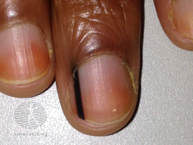 File:Racial melanonychia (DermNet NZ hair-nails-sweat-melanonychia-16).jpg