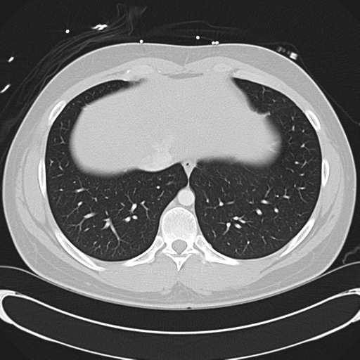 File:'Bovine' aortic arch (Radiopaedia 33554-34637 Axial lung window 49).png