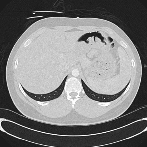 File:'Bovine' aortic arch (Radiopaedia 33554-34637 Axial lung window 61).png
