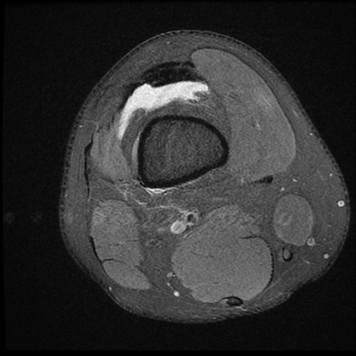 File:ACL acute full thickness tear - deep lateral femoral sulcus sign (Radiopaedia 38594-40740 Axial PD fat sat 2).jpg