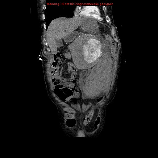 Abdominal aortic aneurysm- extremely large, ruptured (Radiopaedia 19882-19921 Coronal C+ arterial phase 28).jpg
