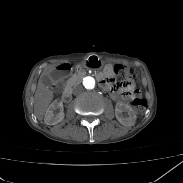 Abdominal aortic aneurysm (Radiopaedia 23703-23856 Axial C+ arterial phase 33).jpg