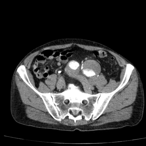 Abdominal aortic aneurysm (Radiopaedia 29248-29660 Axial C+ arterial phase 66).jpg