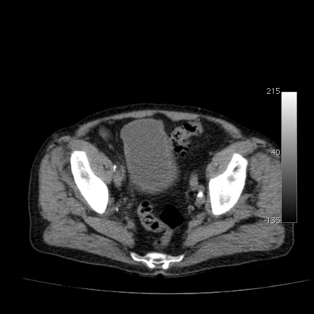 Abdominal aortic aneurysm (Radiopaedia 29248-29660 Axial non-contrast 49).jpg