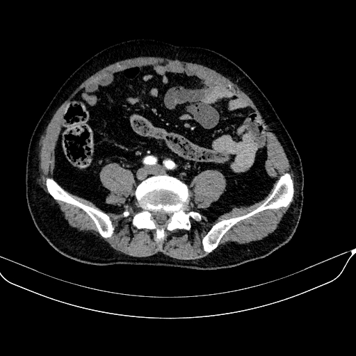 Abdominal aortic aneurysm (Radiopaedia 67117-76452 Axial C+ arterial phase 93).jpg