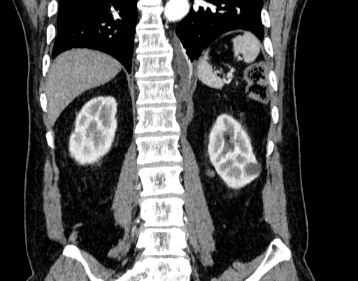 Abdominal aortic aneurysm (Radiopaedia 67117-76452 Coronal C+ arterial phase 77).jpg