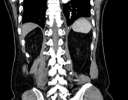 Abdominal aortic aneurysm (Radiopaedia 67117-76452 Coronal C+ arterial phase 90).jpg