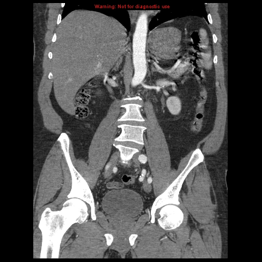 Abdominal aortic aneurysm (Radiopaedia 8190-9038 Coronal C+ arterial phase 73).jpg
