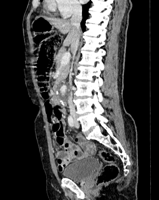 Abdominal aortic aneurysm (Radiopaedia 83581-98689 Sagittal C+ portal venous phase 39).jpg