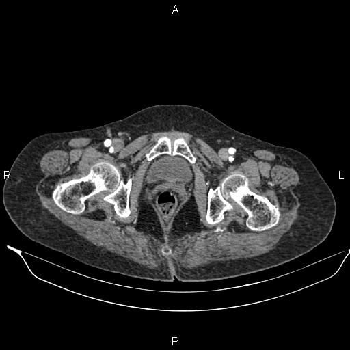 File:Abdominal aortic aneurysm (Radiopaedia 85063-100606 Axial C+ arterial phase 65).jpg