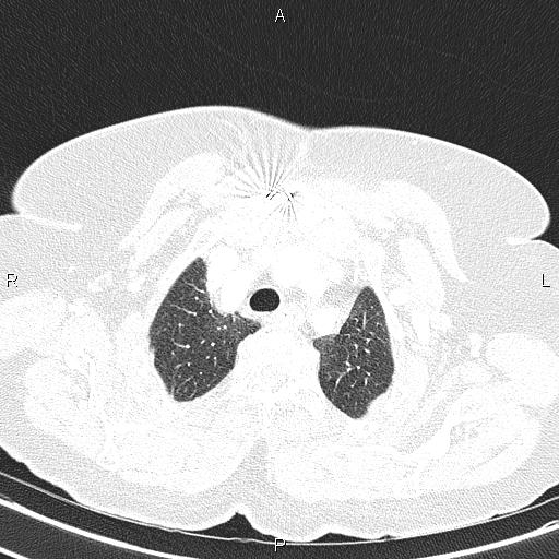Abdominal aortic aneurysm (Radiopaedia 85063-100606 Axial lung window 16).jpg