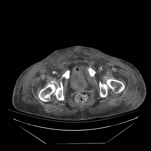 Abdominal aortic aneurysm - impending rupture (Radiopaedia 19233-19247 Axial non-contrast 162).jpg