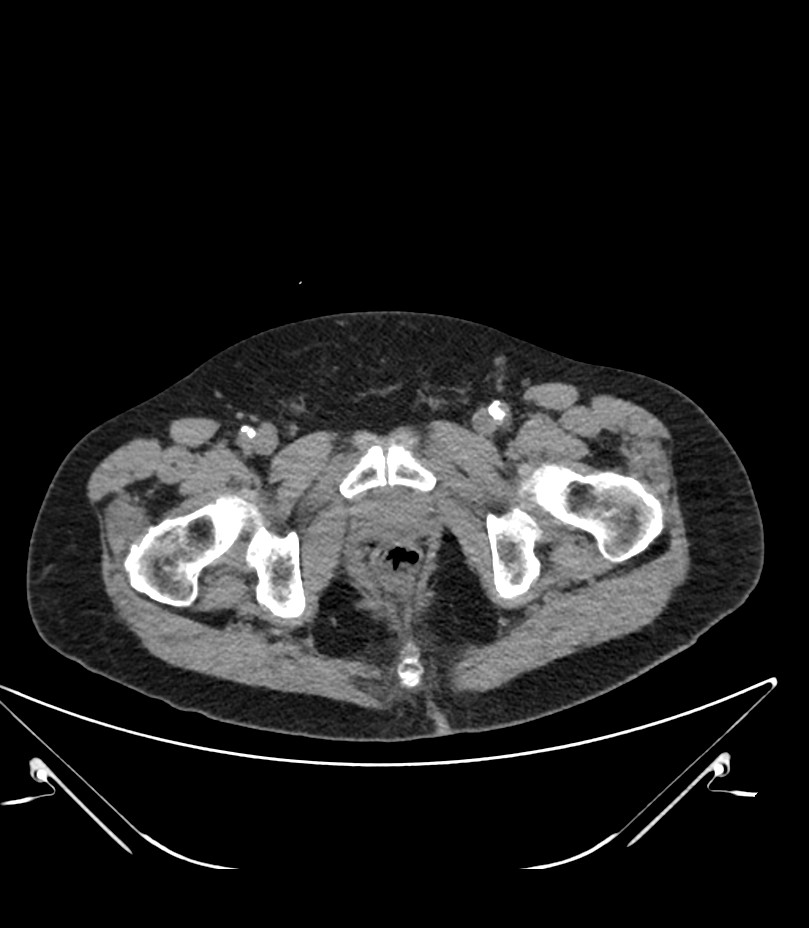 Abdominal aortic aneurysm with thrombus fissuration (Radiopaedia 46218-50618 Axial non-contrast 59).jpg